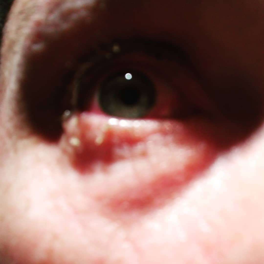 It's official I'm falling apart. Pink eye to go with the cough 😐 stupid 2018