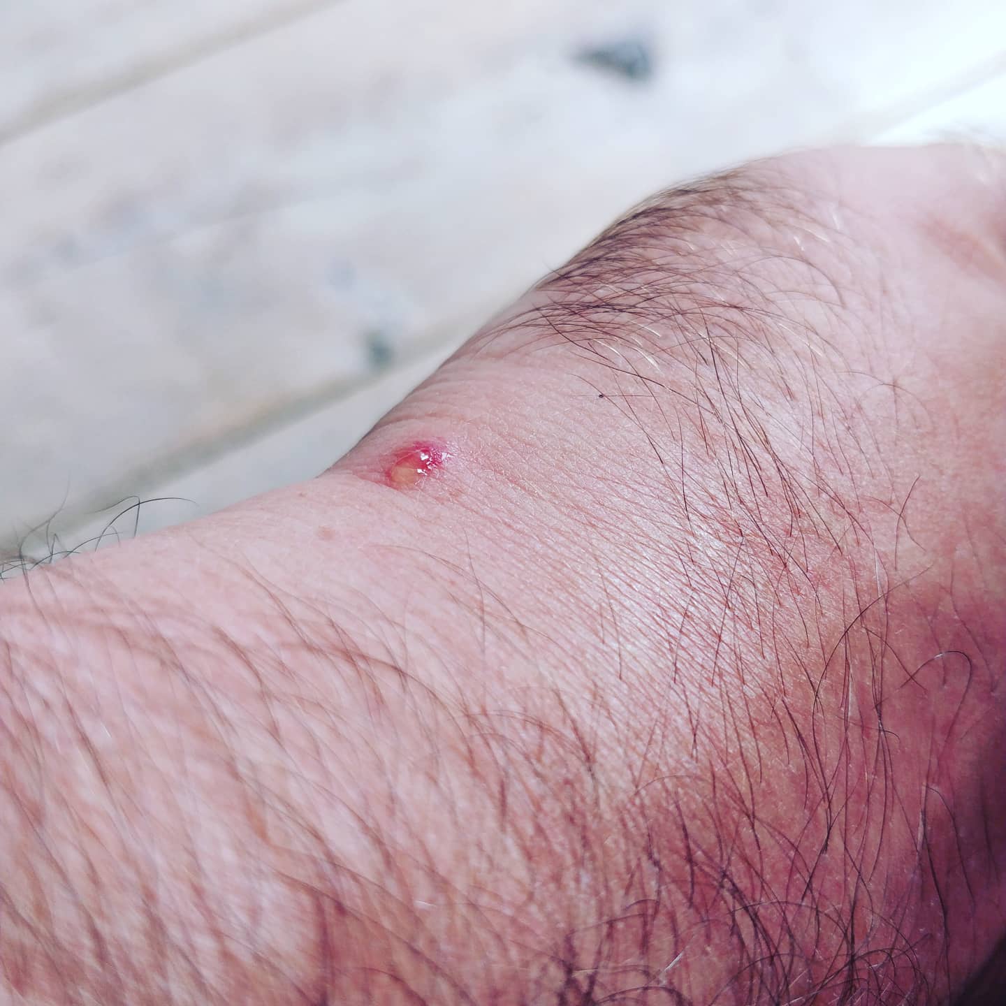 This is why I hate mosquitoes.